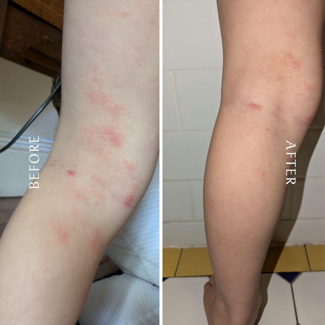 Before and after photo of the back of a child’s knee showing improvement in dry, irritated skin after using natural beef tallow balm — visibly soothed and nourished.