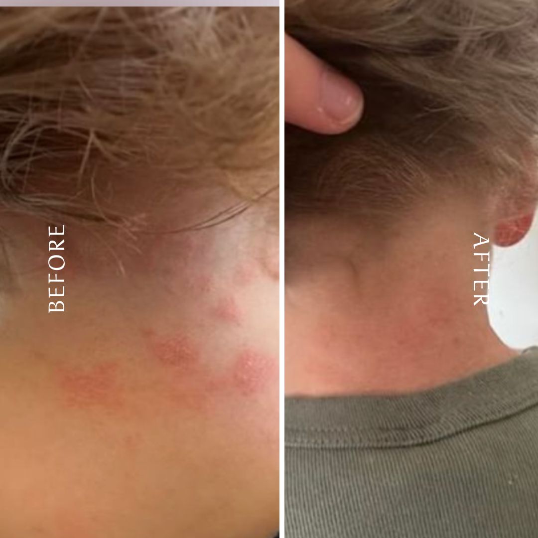 Before and after photo of a person’s neck showing reduced redness and dryness after using natural beef tallow balm — skin appears calmer and more hydrated.