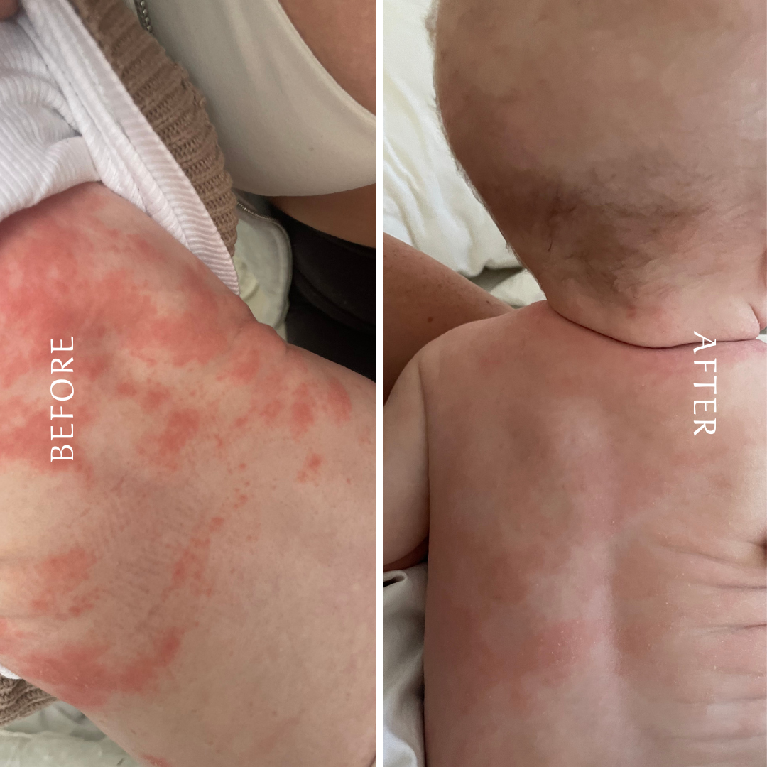 Before and after photo of a baby’s back showing significant reduction in eczema redness and dryness after using natural beef tallow balm for gentle, soothing skincare.
