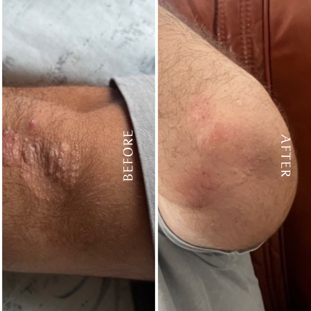 Before and after photo of an elbow showing improved hydration and smoother skin after applying natural whipped tallow body butter for dry, rough skin.
